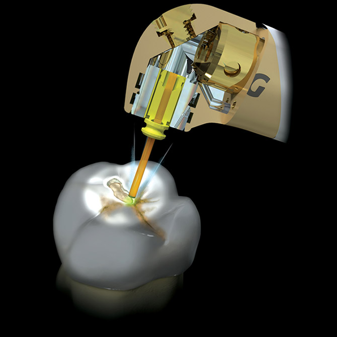 Laser Dentistry in Fort Lauderdale Leads to Better Outcomes for You